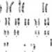 Figure 5: High resolution karyotyping result showing the t(1;22)(p13;q13)